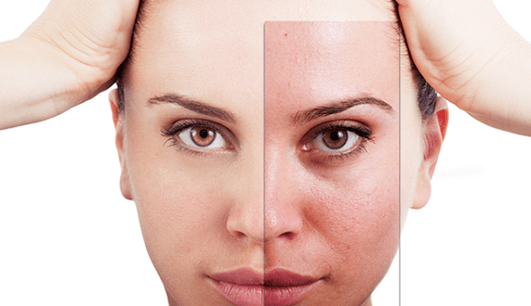 întinerirea fracționată elimină principalele defecte estetice ale feței