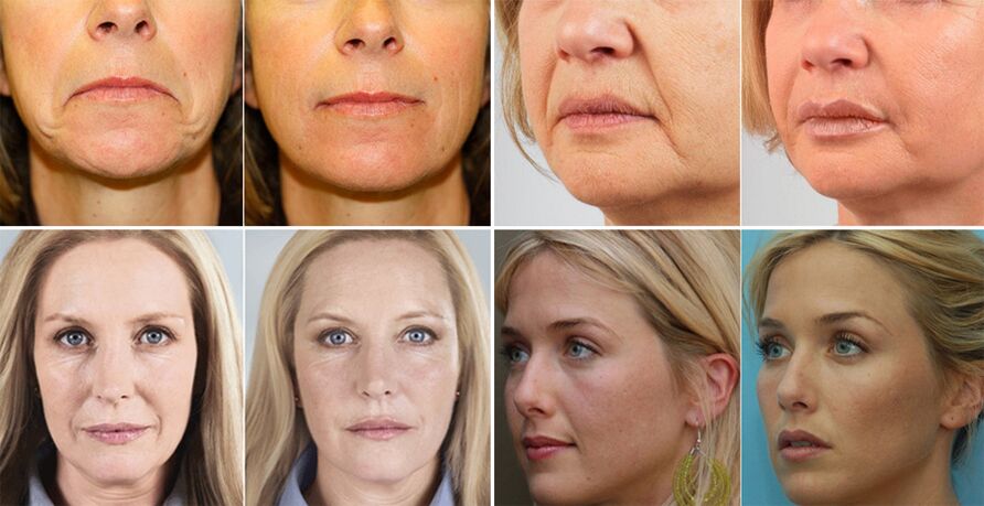 fotografii cu femei înainte și după întinerirea pielii feței